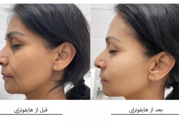 عکس قبل و بعد هایفوتراپی