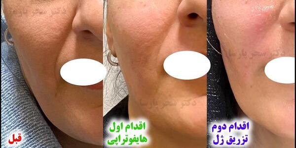 عکس قبل و بعد هایفوتراپی