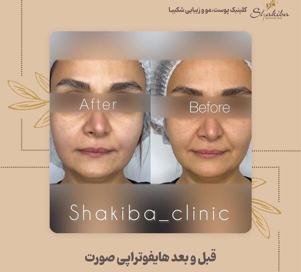 عکس قبل و بعد هایفوتراپی