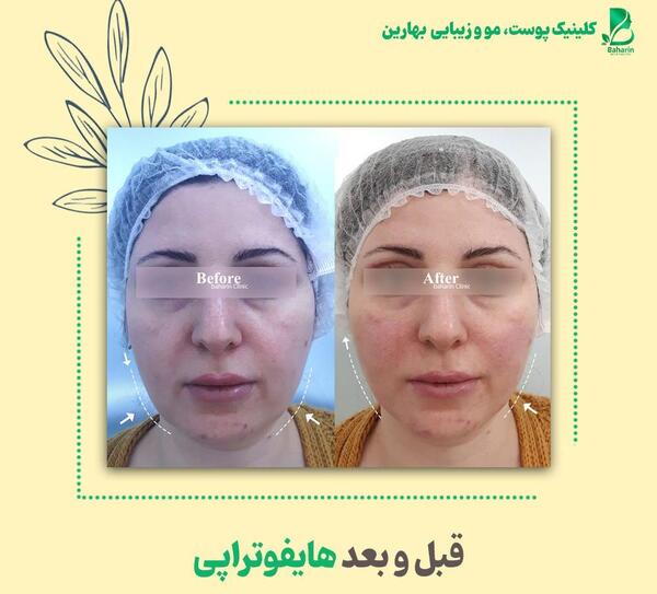 عکس قبل و بعد هایفوتراپی