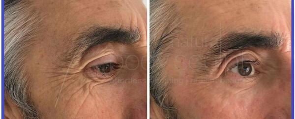 عکس قبل و بعد هایفوتراپی
