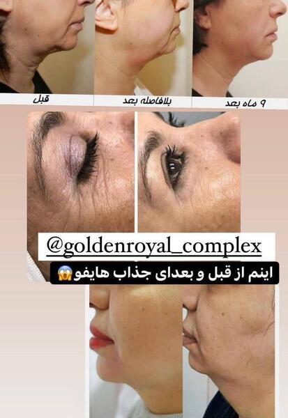 عکس قبل و بعد هایفوتراپی