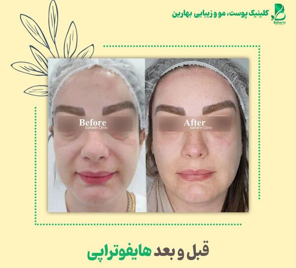عکس قبل و بعد هایفوتراپی