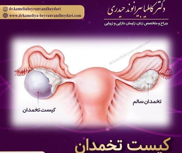 عکس کیست دفع شده در پریودی