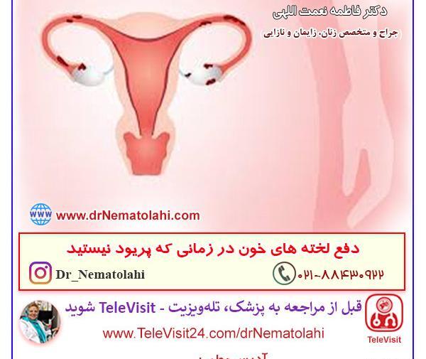 عکس کیست دفع شده در پریودی