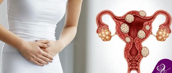 عکس کیست دفع شده در پریودی