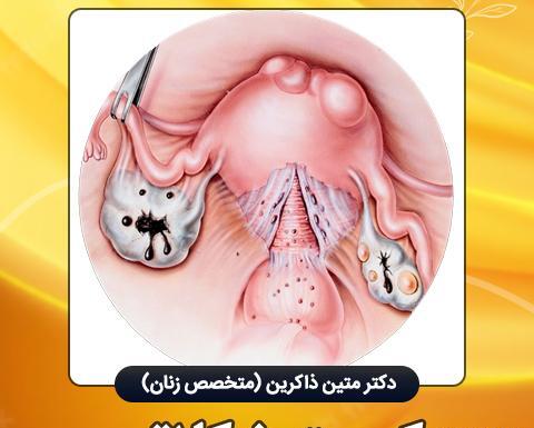 عکس کیست دفع شده در پریودی