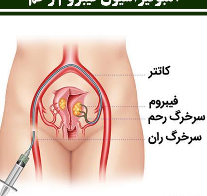 عکس کیست دفع شده در پریودی