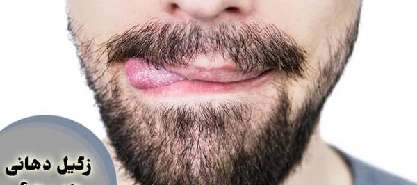 عکس زگیل دهانی