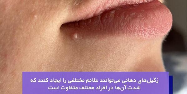 عکس زگیل دهانی