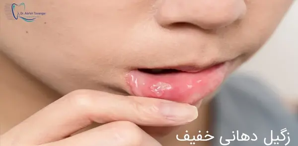 عکس زگیل دهانی