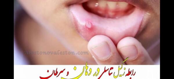عکس زگیل دهانی