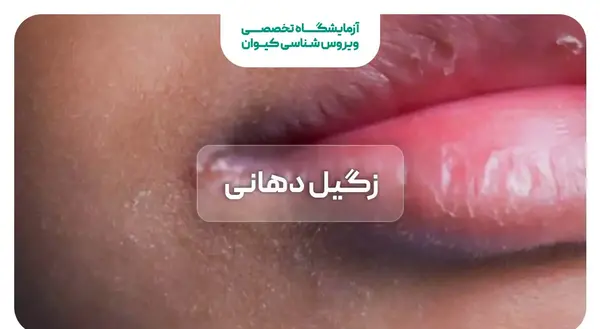عکس زگیل دهانی