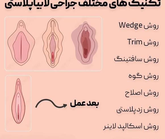 لابيا ماژور عکس های واقعی عمل لابیاپلاستی