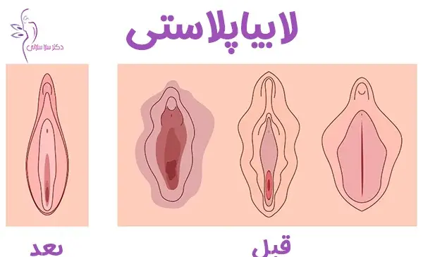 لابيا ماژور عکس های واقعی عمل لابیاپلاستی