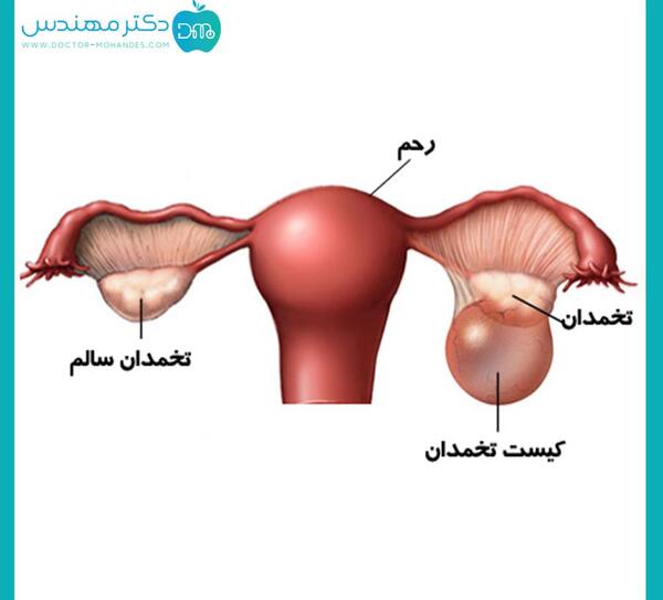 عکس فیبروم دفع شده در پریودی