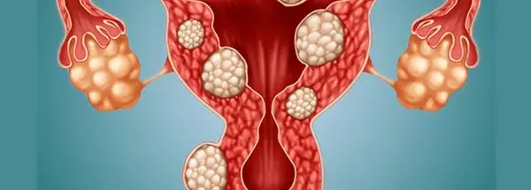 عکس فیبروم دفع شده در پریودی