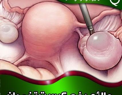 عکس فیبروم دفع شده در پریودی