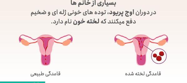 عکس فیبروم دفع شده در پریودی