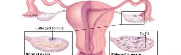 عکس فیبروم دفع شده در پریودی