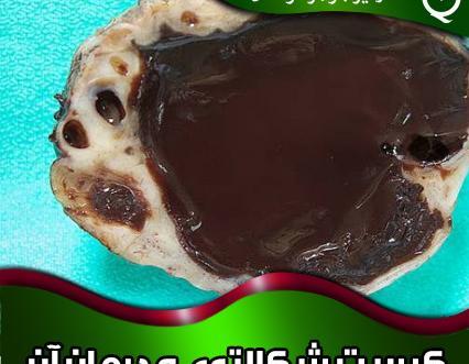 عکس فیبروم دفع شده در پریودی