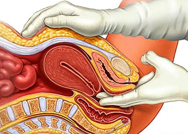 عکس فیبروم دفع شده در پریودی