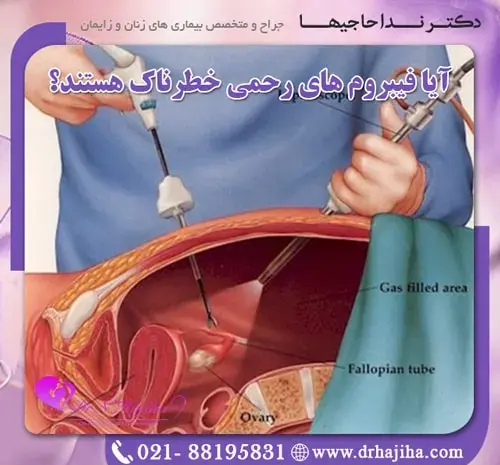 عکس فیبروم دفع شده در پریودی