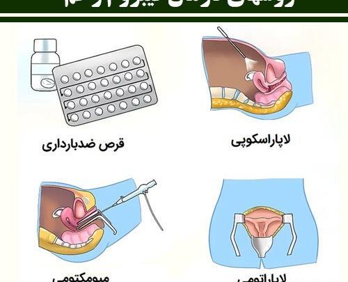 عکس فیبروم دفع شده در پریودی