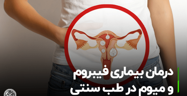عکس فیبروم دفع شده در پریودی