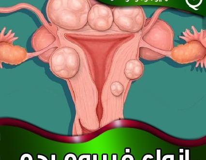 عکس فیبروم دفع شده در پریودی