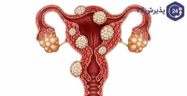 عکس فیبروم دفع شده در پریودی