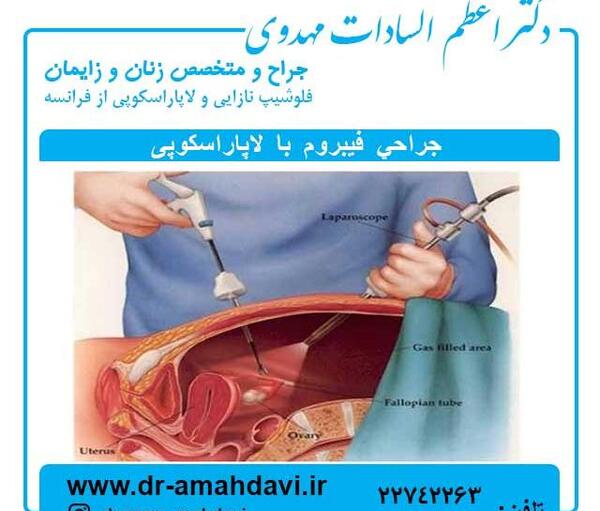 عکس فیبروم دفع شده در پریودی