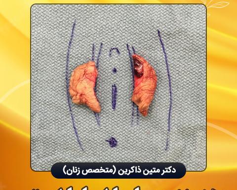 لابياپلاستي عکس های واقعی عمل لابیاپلاستی