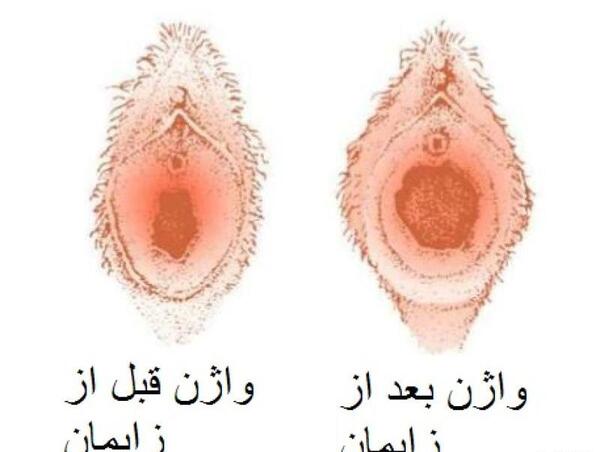 لابياپلاستي عکس های واقعی عمل لابیاپلاستی