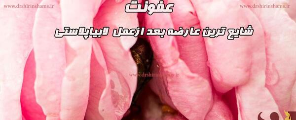 لابياپلاستي عکس های واقعی عمل لابیاپلاستی