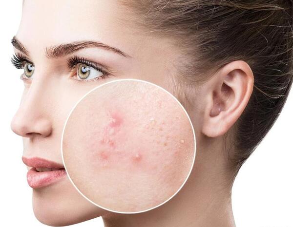 عکس جوش های کبد چرب