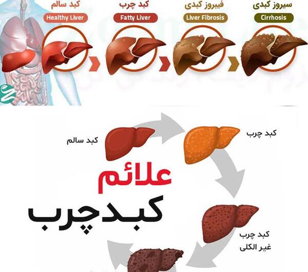 عکس جوش های کبد چرب