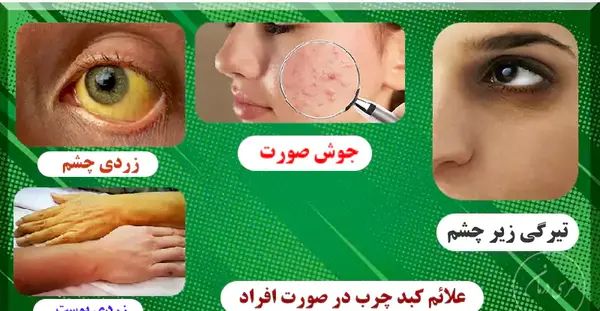 عکس جوش های کبد چرب