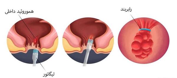 عکس بواسیر بادی