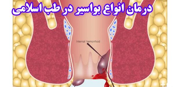 عکس بواسیر بادی