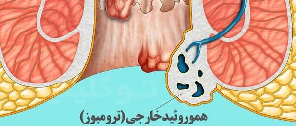 عکس بواسیر بادی