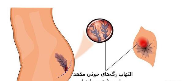 عکس بواسیر بادی