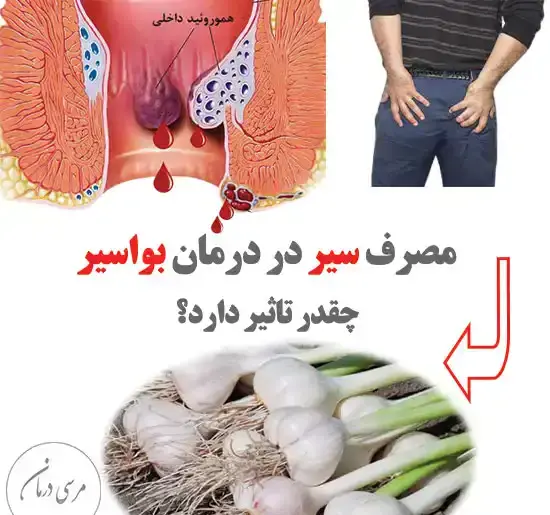 عکس بواسیر بادی