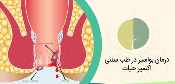 عکس بواسیر بادی