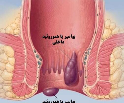 عکس بواسیر بادی