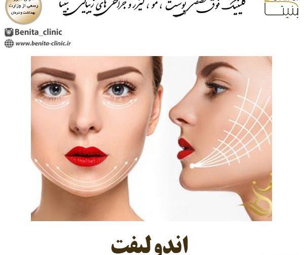 عکس قبل و بعد اندولیفت
