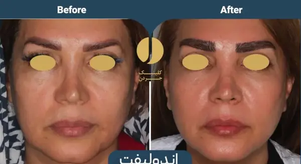 عکس قبل و بعد اندولیفت
