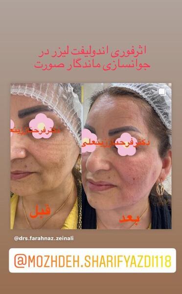 عکس قبل و بعد اندولیفت