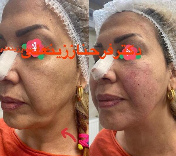 عکس قبل و بعد اندولیفت