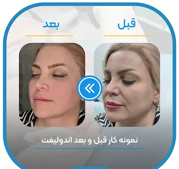 عکس قبل و بعد اندولیفت